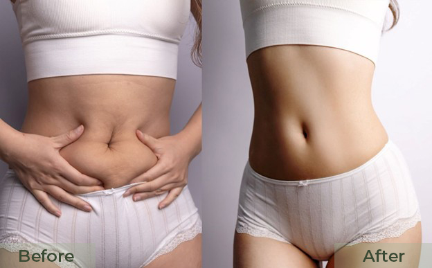 Before and after abdomen slimming showing a flatter stomach.