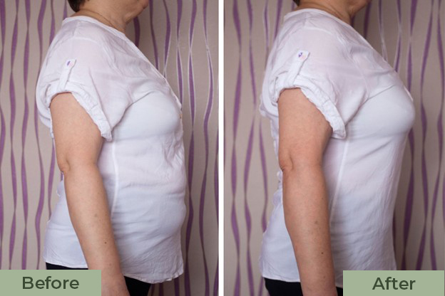 Before and after body contouring showing reduced waistline.